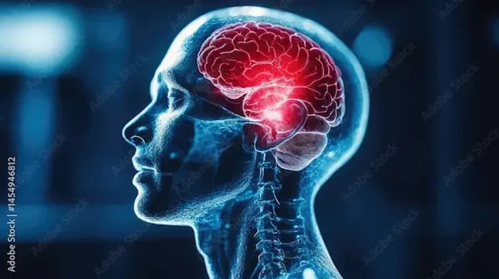 Brain Attack